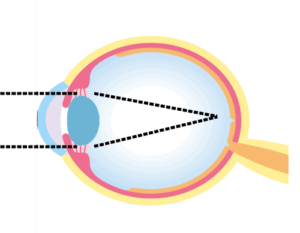 軸性近視のイメージ